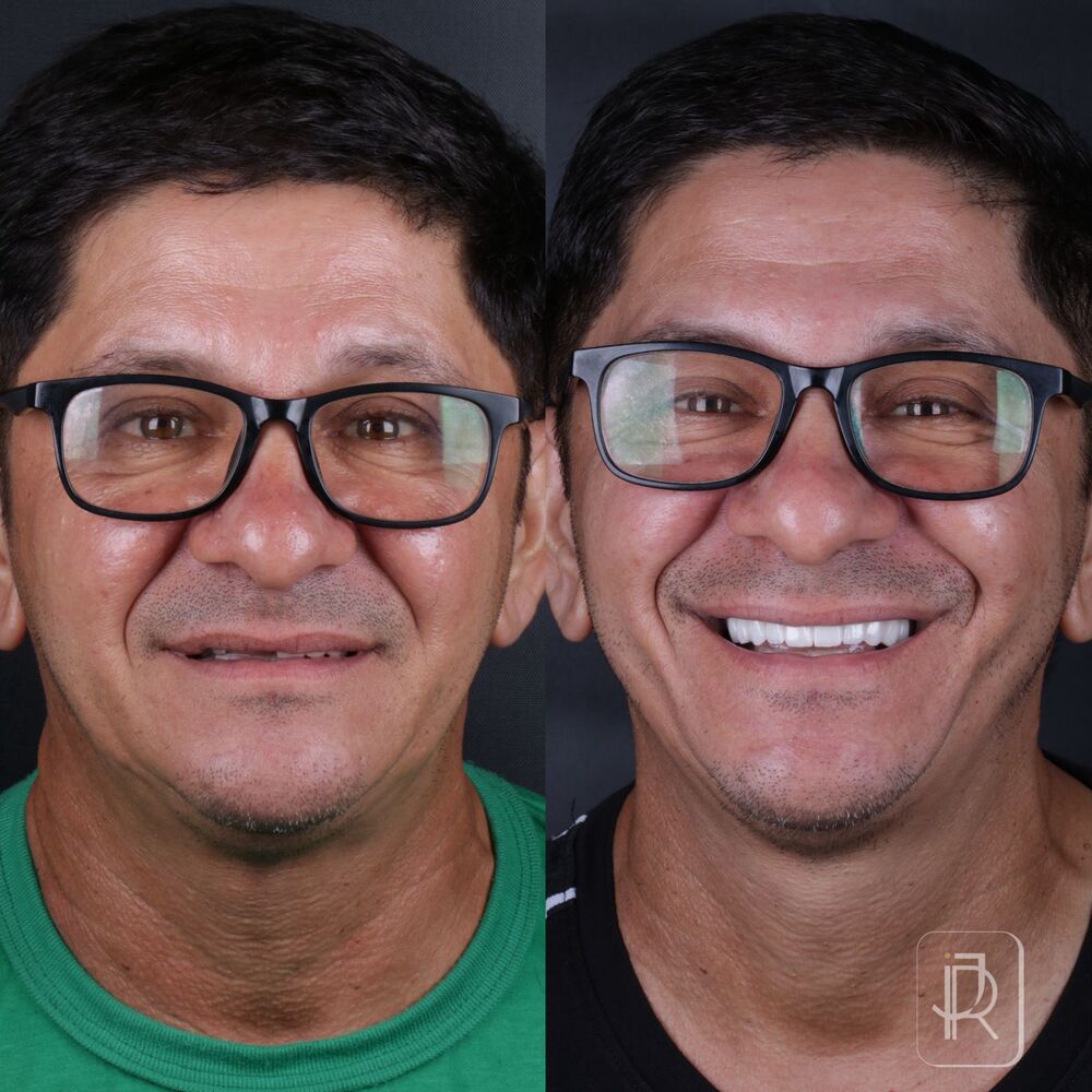Antes e depois de caso real