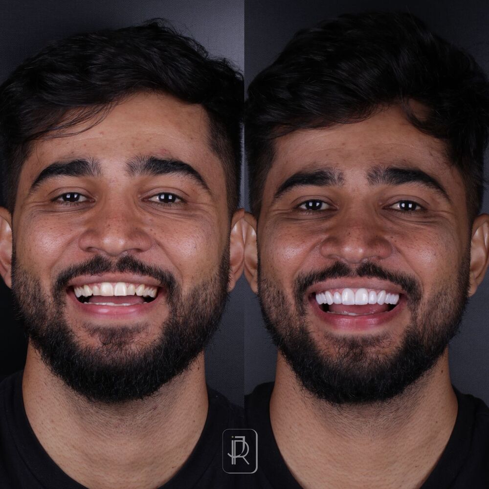Antes e depois de caso real
