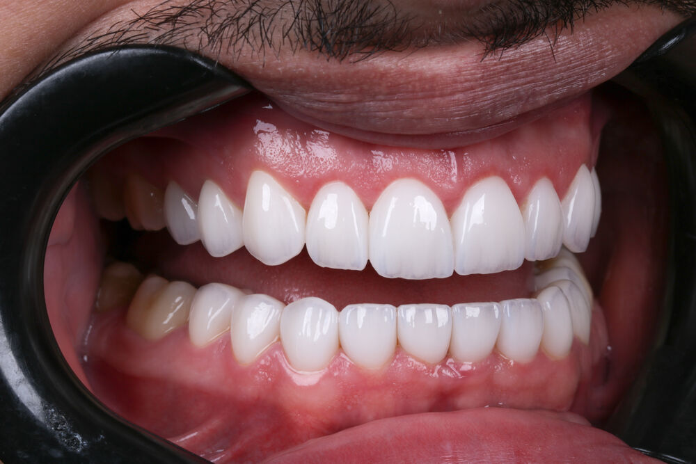 Detalhe de sorriso
